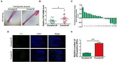 Increased Expression of Zyxin and Its Potential Function in Androgenetic Alopecia